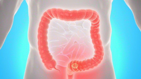 COLORECTAL CANCER & TESTS FOR ITS DIAGNOSIS